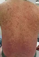 Leukocytoclastic vasculitis