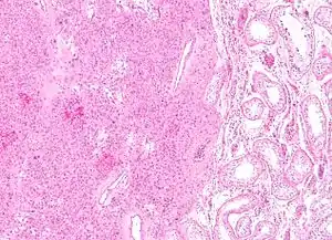 Low magnification micrograph of a Leydig cell tumour. H&E stain.