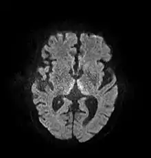Axial MRI B=1000 DWI image showing hyperintense signal indicative of restricted diffusion in the mesial dorsal thalami.