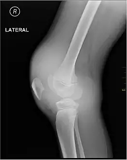 Haemarthrosis on lateral view