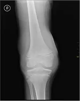X-Ray- haemoarthritis