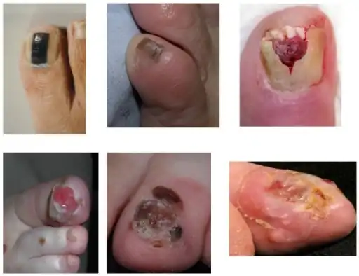 Melanoma nails