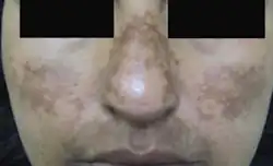 Melasma