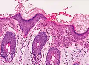Superficially invasive squamous cell carcinoma (SCCSI). These lesions often do not show the marked pleomorphism and atypical nuclei of SCC in situ, but demonstrate early keratinocyte invasion of the dermis.