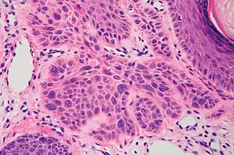 High magnification demonstrates the pleomorphism of the invading keratinocytes.