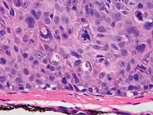 SCC in situ, high magnification, demonstrating an intact basement membrane.