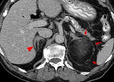 Myeloplipoma shown on a CT scan image