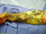 Necrotizing fasciitis type III caused by vibrio vulnificus.