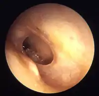 Otitis media chronica mesotympanalis