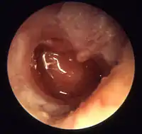 Chronic otitis media (otitis media chronica mesotympanalis)