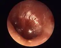 Myringitis bullosa in influenza
