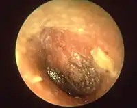 Acute otitis media