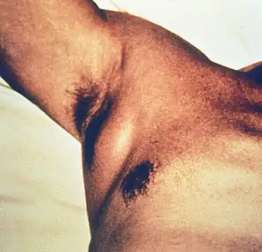 Swollen axillary lymph node