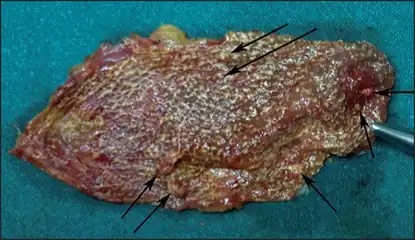 Cut-opened specimen of gallbladder (strawberry) shows multiple polyps