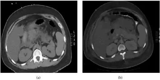 Pegaspargase Induced Hypertriglyceridemia-a)Enlarged pancreas with peripancreatic inflammatory changes b) interval worsening of acute pancreatitis