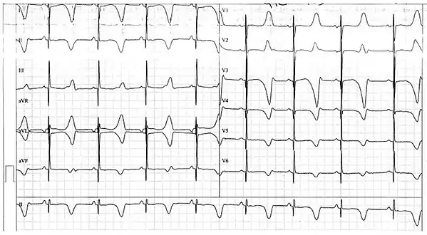 ECG from a 10-year-old boy with Jervell and Lange-Nielsen syndrome