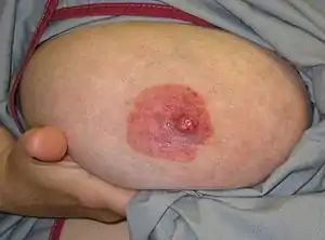 Paget disese of the nipple