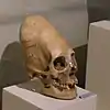 A skull with cranial deformation, resulting in an extended skull