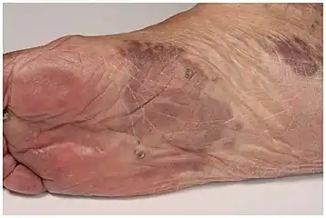 Patch stage Kaposi's sarcoma. Red to brownish irregularly shaped macules and plaques.