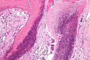 Micrograph of a pilomatricoma showing the characteristic "ghost" cells (anucleate squamous cells), benign viable squamous cells and multi-nucleated giant cells. H&E stain.