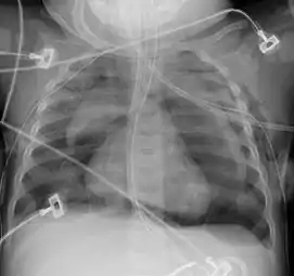 Pneumomediastinum with angel wing sign