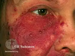 Port-wine stain