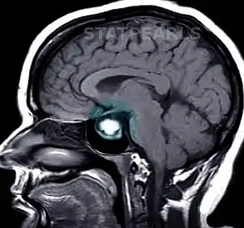 Prolactinoma on MRI