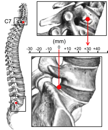 Sagittal balance measurement.
