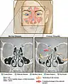 CT of chronic sinusitis