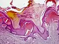 Angiokeratoma (Mibelli type)