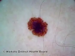 Superficial spreading melanoma, Breslow 0.4 mm, nonpolarised dermoscopy view