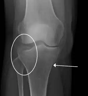 A tibial plateau fracture seen on X-ray