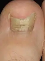 Nail candidiasis