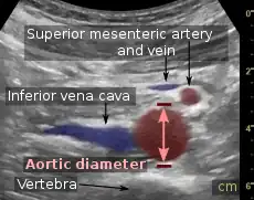 Aortic measurement on abdominal ultrasonography in the axial plane between the outer margins of the aortic wall.
