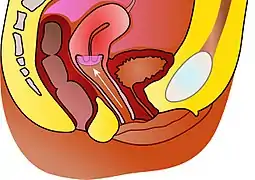 A contraceptive diaphragm.